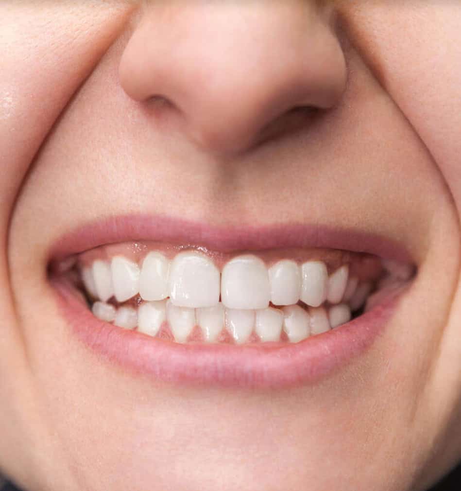 Smile after dental restoration